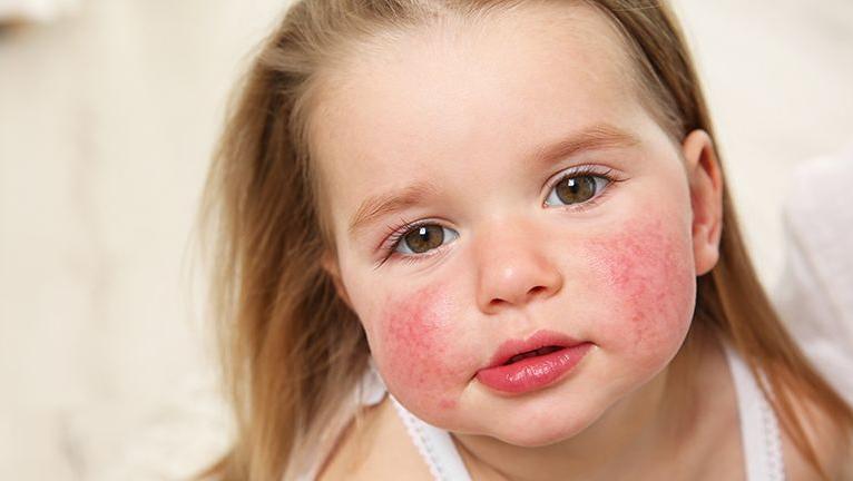 Pakiet badań - alergiczny pediatryczny (27 alergenów)