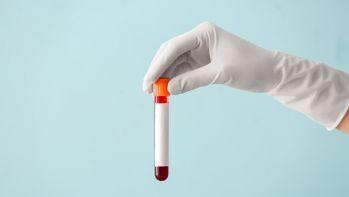 Pakiet badań Profilaktyka przedekspozycyjna HIV (PrEP) – do wizyty kwalifikującej