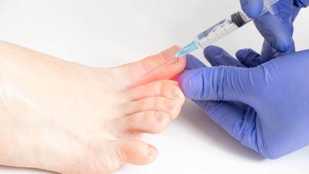Toksyna Botulinowa Botox/Vistabel- leczenie nadpotliwości stóp