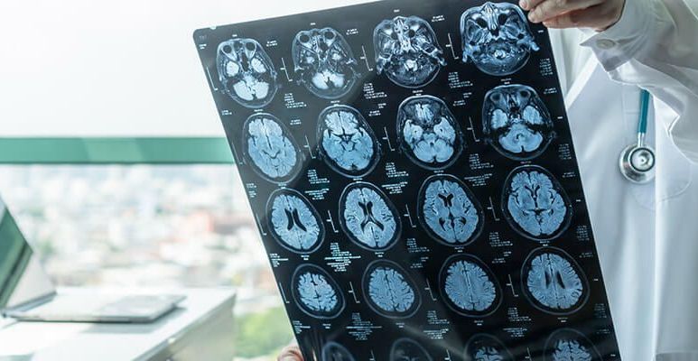 Choroba Alzheimera – przyczyny, diagnoza, leczenie