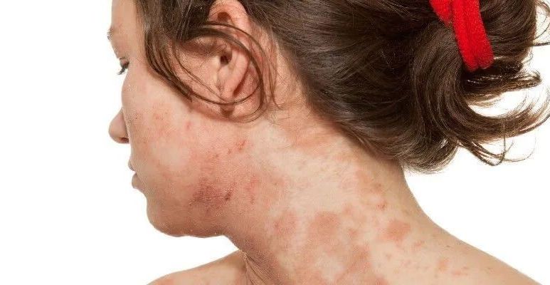 Atopowe zapalenie skóry - przyczyny, objawy i leczenie AZS