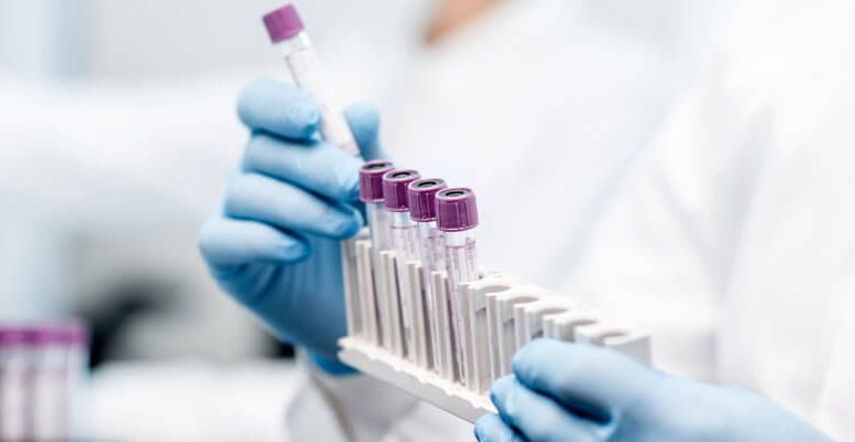 Kreatynina - co to jest, kiedy badać i jakie są normy?