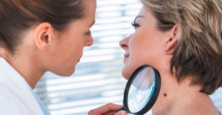 Czerniak – czynniki ryzyka, objawy i diagnostyka nowotworu skóry