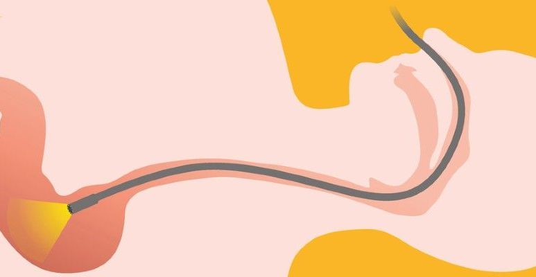 Rysunek przedstawiający rurkę endoskopu w przewodzie pokarmowym człowieka