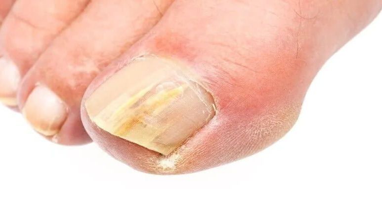 Grzybica paznokci – przyczyny, objawy, leczenie i profilaktyka