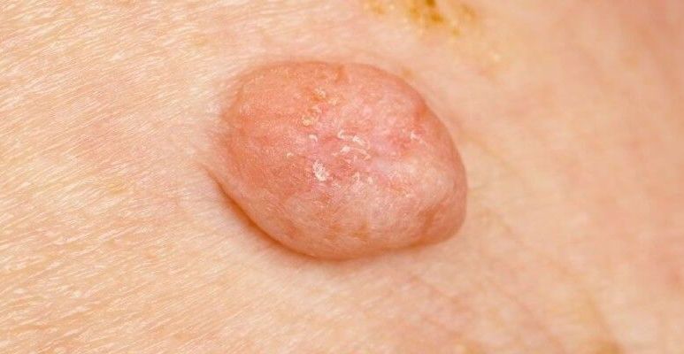 Wirus HPV (wirus brodawczaka ludzkiego) – zakażenie, objawy, leczenie