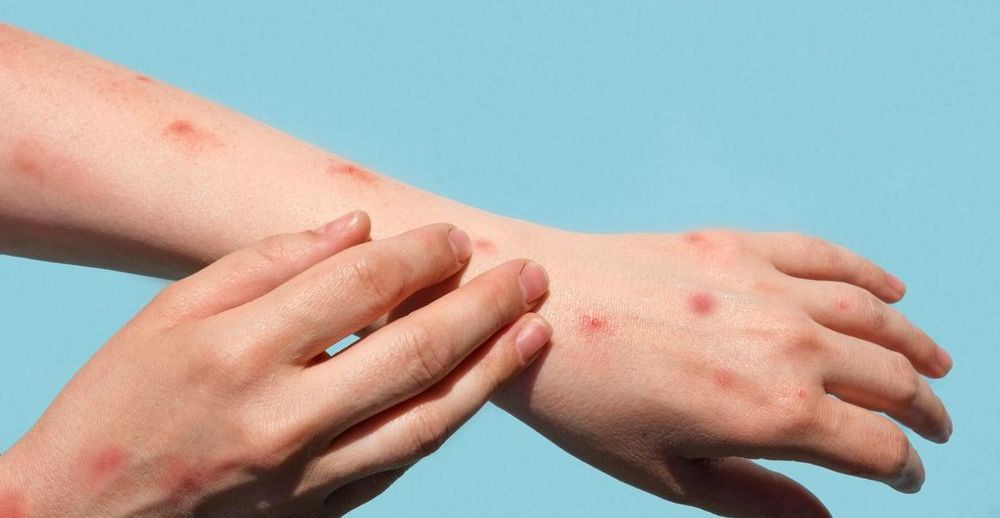 Jakie są objawy małpiej ospy?