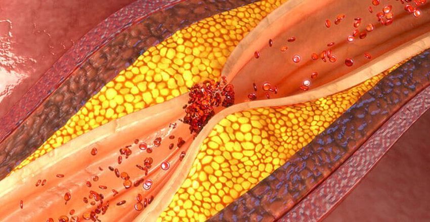 Schemat zwężonej tętnicy i blaszki miażdżycowej