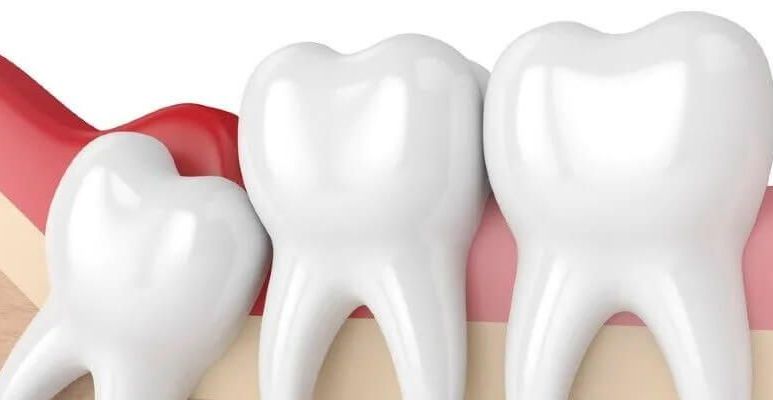 Chirurgiczne usuwanie ósemek - co warto wiedzieć?