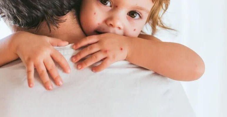 Ospa wietrzna u dzieci i dorosłych - objawy ospy, przebieg choroby