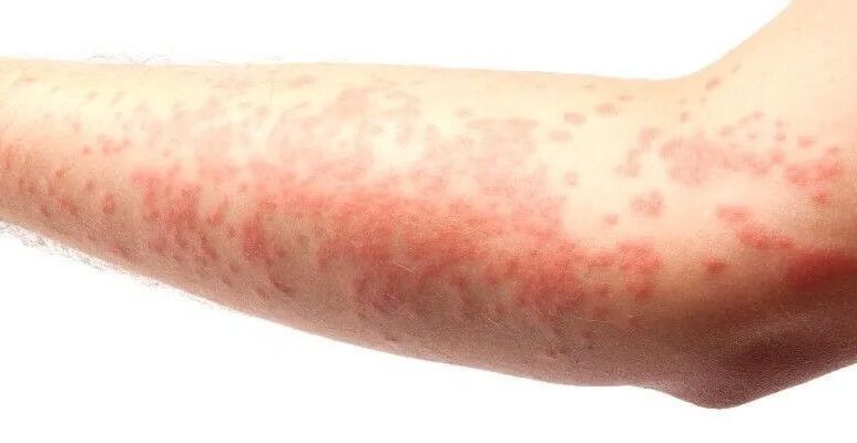 Jak wygląda świerzb? Objawy i leczenie