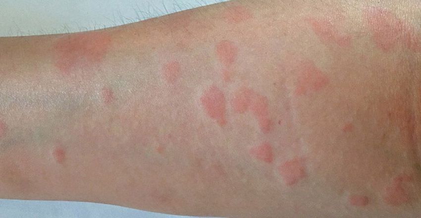 Charakterystyczna wysypka na skórze towarzysząca toczniowi rumieniowatemu
