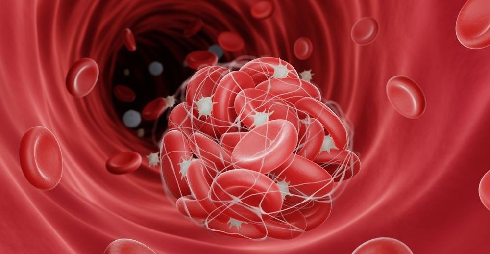 Na czym polega leczenie trombofilii?