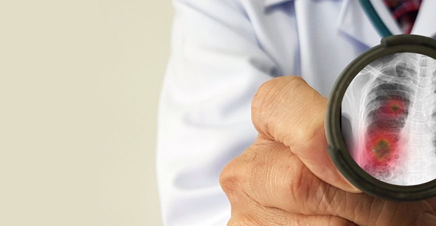 Lekarz trzyma stetoskop. Na jego głowicy jest zdjęcie rentgenowskie płuc.