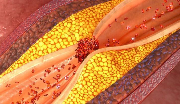 Schemat zwężonej tętnicy i blaszki miażdżycowej