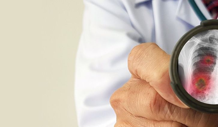 Lekarz trzyma stetoskop. Na jego głowicy jest zdjęcie rentgenowskie płuc.