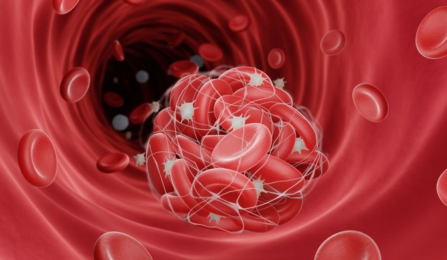 Na czym polega leczenie trombofilii?