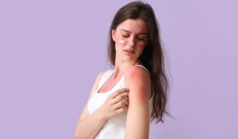 uczulenie na słońce