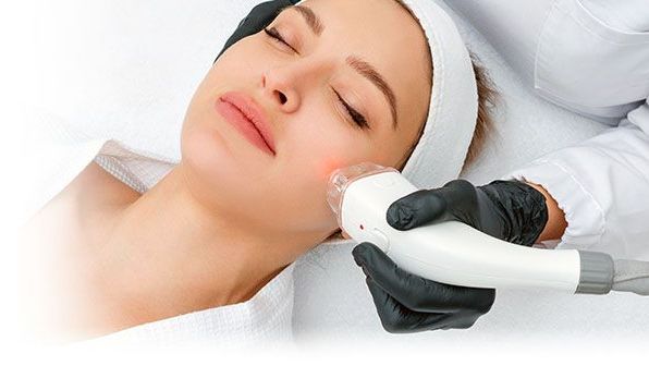 Laser Nd:Yag - usuwanie naczyń na policzkach