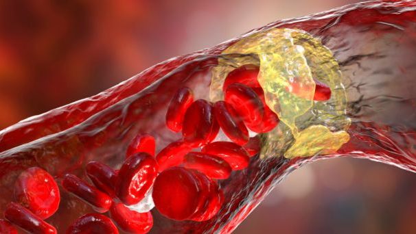 Profil - Ryzyko miażdżycy