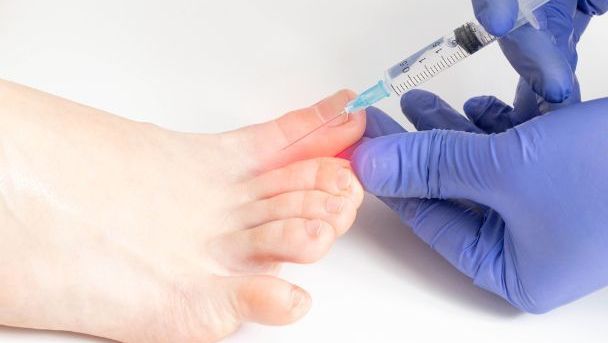 Toksyna Botulinowa Botox/Vistabel- leczenie nadpotliwości stóp