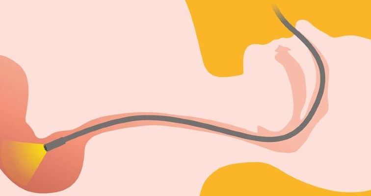 Rysunek przedstawiający rurkę endoskopu w przewodzie pokarmowym człowieka