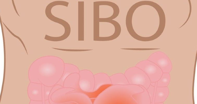 Rysunek brzucha z napisem SIBO i ilustracją jelit