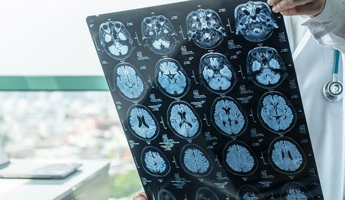 Choroba Alzheimera – przyczyny, diagnoza, leczenie