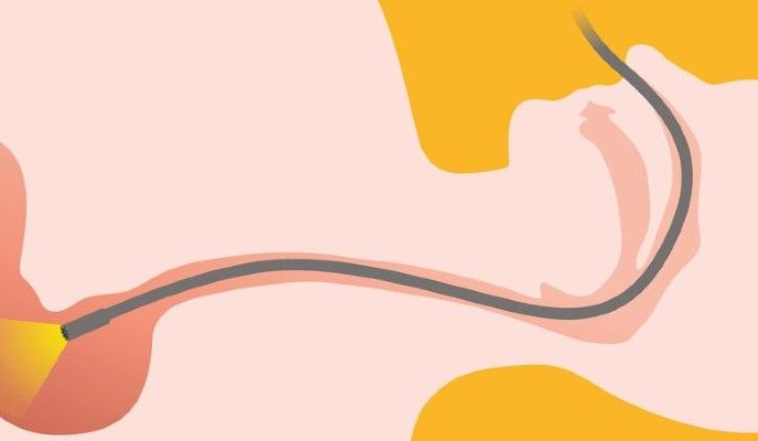 Rysunek przedstawiający rurkę endoskopu w przewodzie pokarmowym człowieka