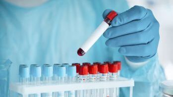 P.ciała przeciw kleszczowemu zapaleniu mózgu IgG