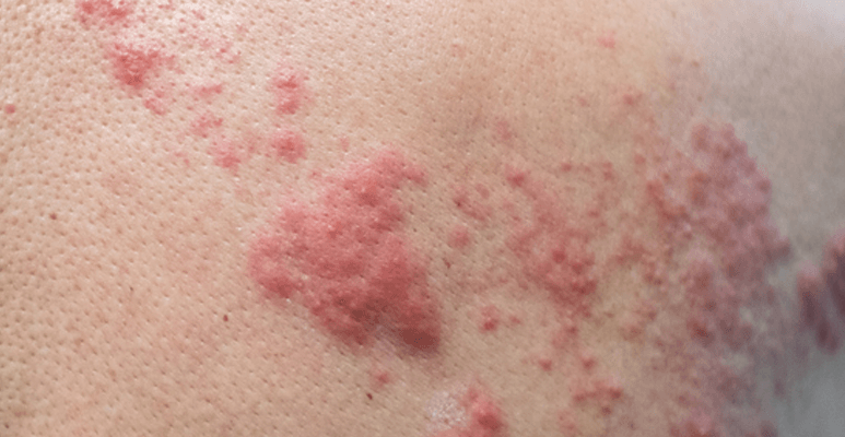 Objawem półpaśca są zmiany skórne, zazwyczaj po jednej stronie ciała.