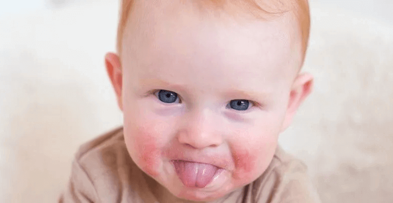 Alergia pokarmowa objawy