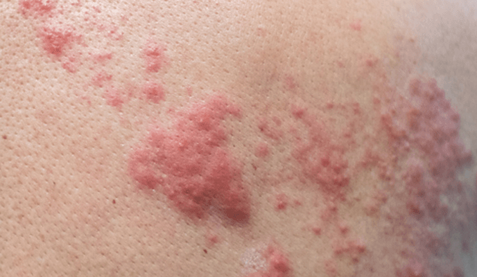 Objawem półpaśca są zmiany skórne, zazwyczaj po jednej stronie ciała.