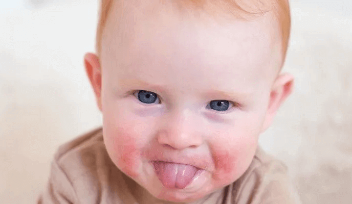 Alergia pokarmowa objawy