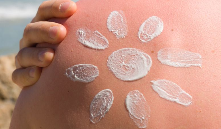 Pierwsze objawy oparzenia słonecznego pojawiają się do pierwszych 12 godzin po ekspozycji. Szczególnie narażona na oparzenia słoneczne jest twarz. Pierwsza pomoc w przypadku oparzenia słonecznego to stopniowe ochłodzenie i nawilżenie skóry.