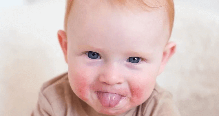 Alergia pokarmowa objawy